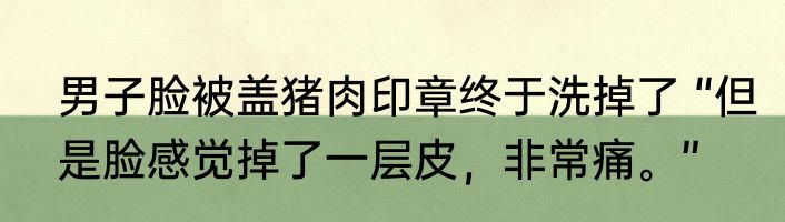 男子脸被盖猪肉印章终于洗掉了 “但是脸感觉掉了一层皮，非常痛。”